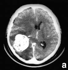 Brain Tumor Detection using ML
